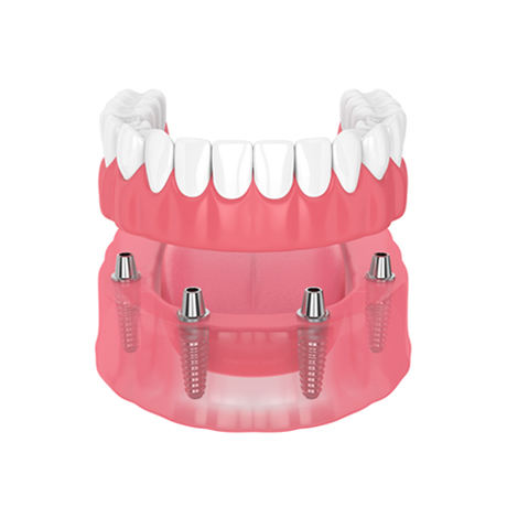Full Arch/Full Mouth Implants