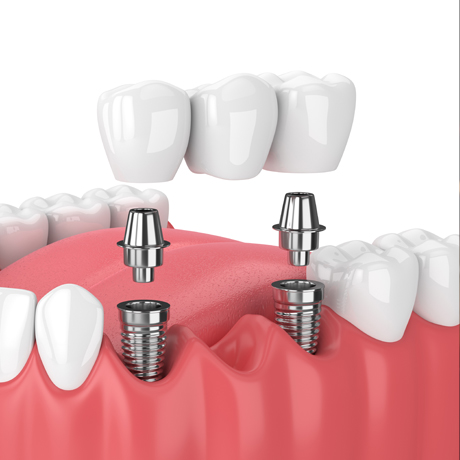 Implant Retained Bridges
